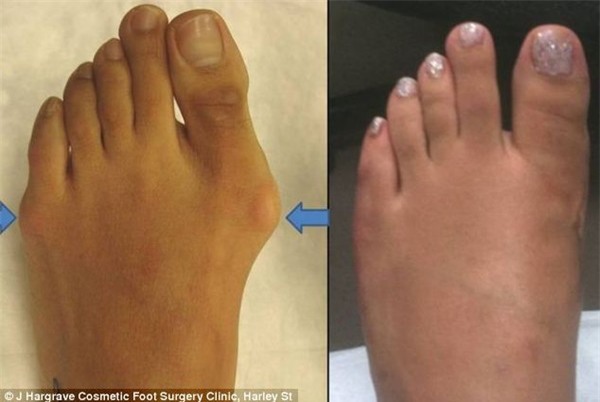 Bi kịch những đôi chân túa máu vì giày cao gót khiến chị em phát sợ - Ảnh 5.