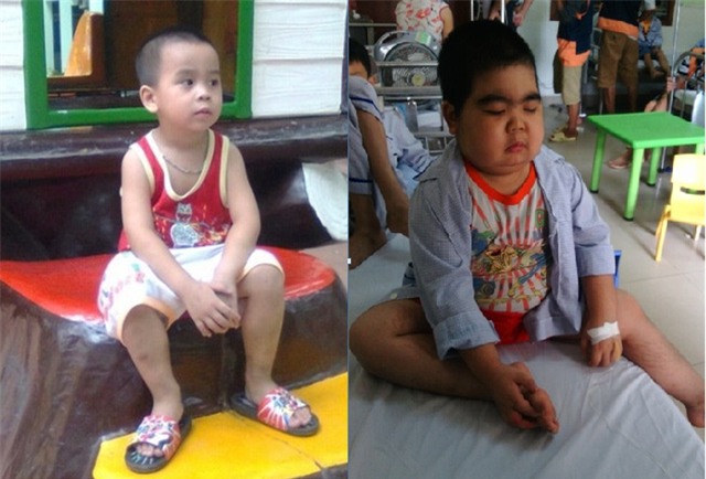 Căn bệnh đã khiến bé Vũ Thái biến dạng khiến nhiều người không còn nhận ra cậu bé kháu khỉnh, đáng yêu ngày nào.