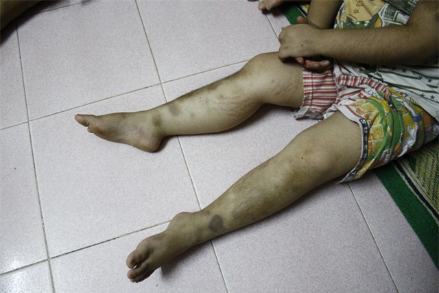 Những vết thâm tím xuất hiện ngày một nhiều khắp cơ thể gây đau đớn dù cháu vẫn chịu khó vâng lời bác sĩ uống thuốc hàng ngày.