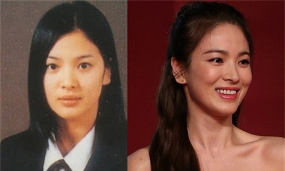Song Hye Kyo phẫu thuật thẩm mỹ 2
