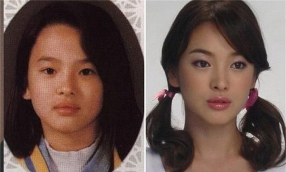 Song Hye Kyo phẫu thuật thẩm mỹ 2