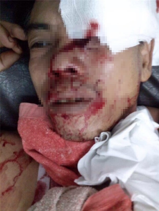 Ông Thiệt với vết thương ở vùng mặt do tên Tùng gây ra