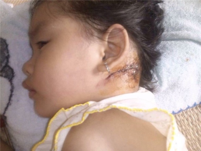 Bé Nguyễn Ngọc Thảo Vy với vết thương sau gáy