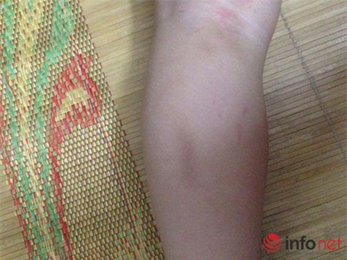 ha noi: be 17 thang tuoi tham tim nguoi khi o truong mam non ve - 2