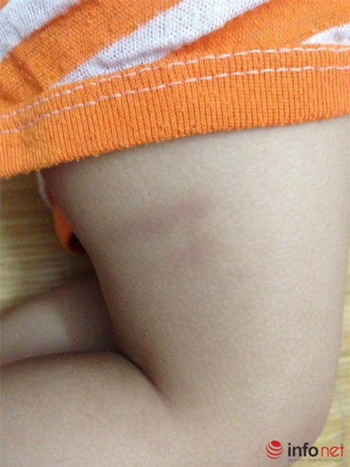 ha noi: be 17 thang tuoi tham tim nguoi khi o truong mam non ve - 3