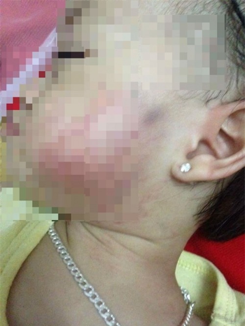 Bé gái bị bầm tím mặt: Cô giáo xin lỗi tiết lộ sự thật 'sốc'? - Ảnh 1