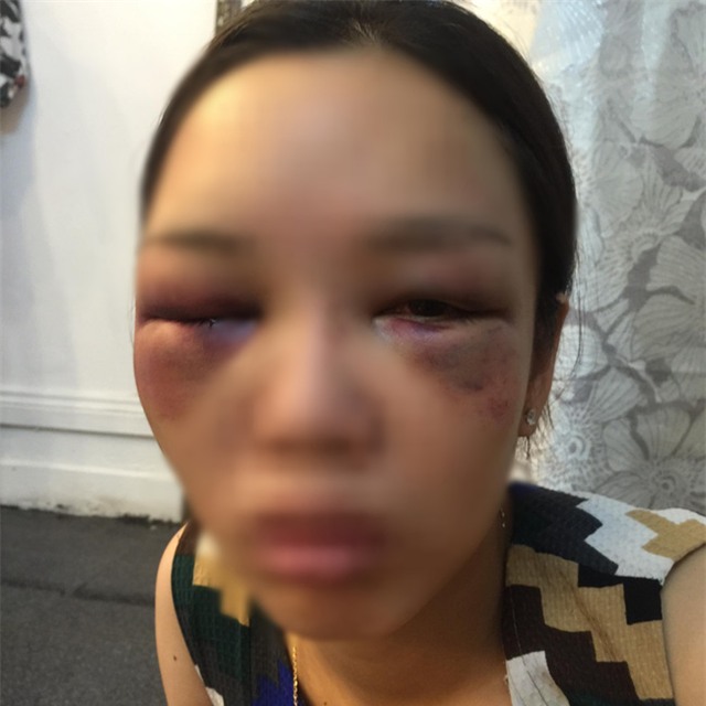 Cô gái trẻ bị người yêu đánh bầm dập mặt vì níu kéo không thành - Ảnh 2.