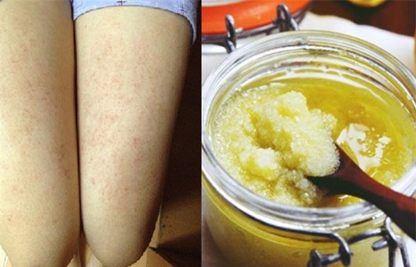 8 cách xóa bỏ những đốm thâm ở chân để bạn tự tin diện váy ngắn