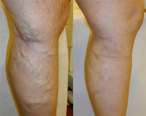 Bệnh suy giãn tĩnh mạch chân: tưởng đơn giản nhưng coi chừng biến chứng nguy hiểm