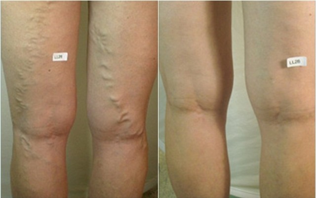 Suy giãn tĩnh mạch chân: Dễ biến chứng nguy hiểm vì... chủ quan