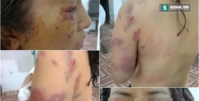 Giáo viên tiểu học bị chồng đánh thâm tím khắp cơ thể?