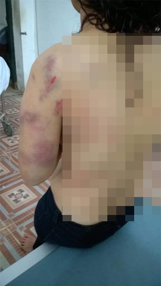 Giáo viên tiểu học bị chồng đánh thâm tím khắp cơ thể? - Ảnh 1.