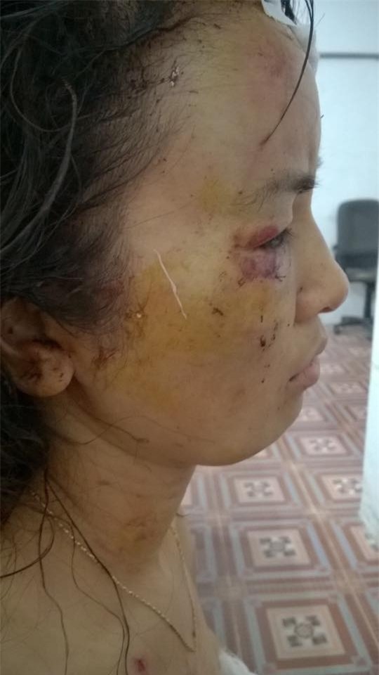 Giáo viên tiểu học bị chồng đánh thâm tím khắp cơ thể? - Ảnh 2.