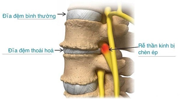 thoái hóa đĩa đệm, Võ Xuân Sơn, đau thắt lưng, cột sống