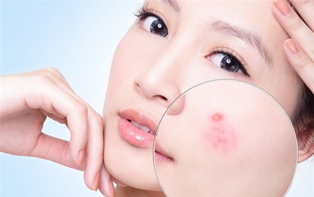 Công thức mặt nạ kì diệu giúp bạn đánh bay mụn chỉ sau 1 tuần