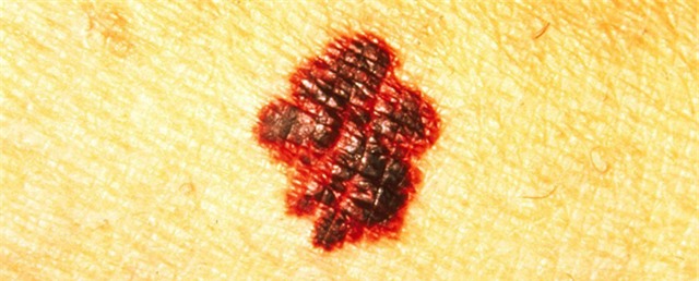 Nguy hiểm chết người đến từ những cái nốt ruồi tưởng vô hại - Ảnh 1.