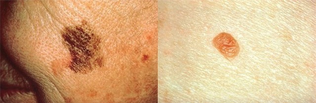 Nguy hiểm chết người đến từ những cái nốt ruồi tưởng vô hại - Ảnh 4.