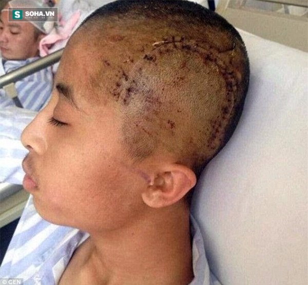 Ngủ ngáy quá to, nam thanh niên bị bạn cùng phòng đánh nứt sọ - Ảnh 1.