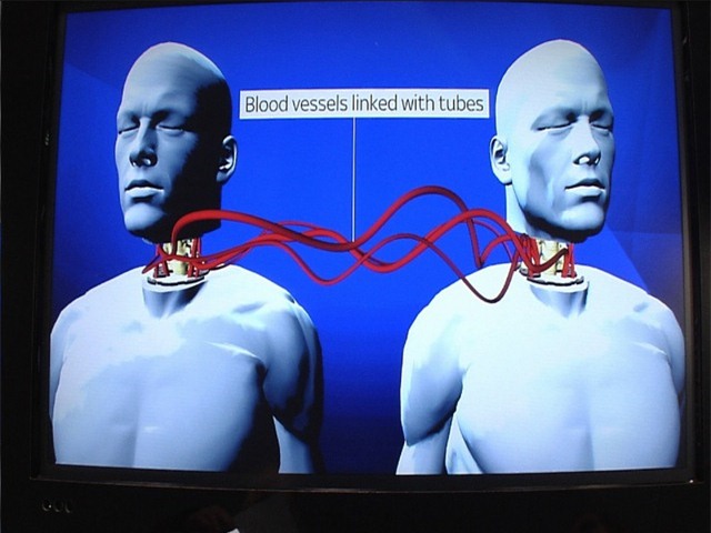 TQ sẽ ghép đầu người lần đầu tiên trong lịch sử - 1