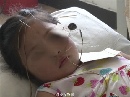 Cảnh báo: Trẻ bị méo mồm, liệt mặt do nằm phòng điều hòa liên tục - Ảnh 3.