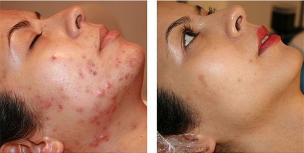 hanh-la-tri-mun-trung-ca-blogtamsuvn2jpg