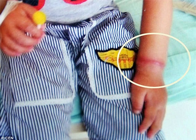 Cảnh báo: Cậu bé 4 tuổi suýt bị cắt tay vì một chiếc vòng chun - Ảnh 1.