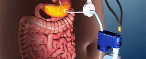 Máy hút thức ăn ra khỏi dạ dày giúp giảm cân nhanh chóng - 1