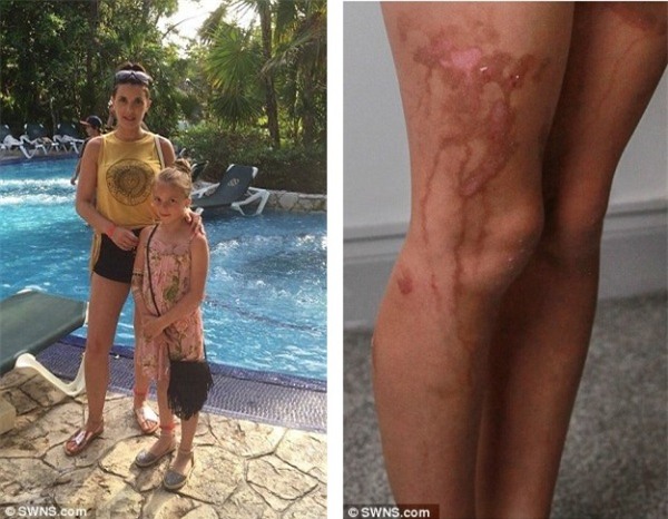 Sử dụng kem chống nắng, bé 9 tuổi bị bỏng nặng hệt như bị tạt axit - Ảnh 2.