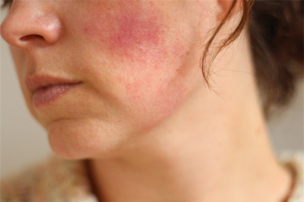 5 tác nhân thường gặp khiến da ngày càng mỏng yếu - Ảnh 1.