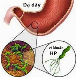 5 đối tượng dễ mắc ung thư dạ dày - Ảnh 1.