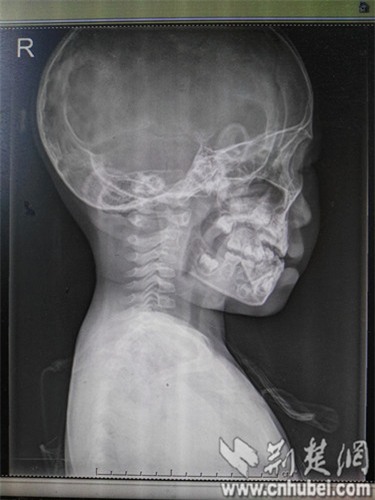 Ôm điện thoại và Ipad, bé 3 tuổi bị lệch cổ, thoái hóa đốt sống - Ảnh 2.