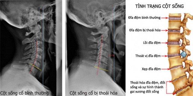 Ôm điện thoại và Ipad, bé 3 tuổi bị lệch cổ, thoái hóa đốt sống - Ảnh 3.