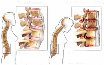 Ôm điện thoại và Ipad, bé 3 tuổi bị lệch cổ, thoái hóa đốt sống - Ảnh 4.