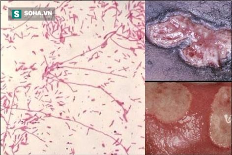 Căn bệnh tình dục vừa nguy hiểm vừa dễ lây ai cũng phải tránh - Ảnh 1.