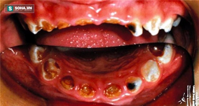 Trẻ thối hết cả hàm răng vì uống nhiều nước ngọt có ga - Ảnh 2.
