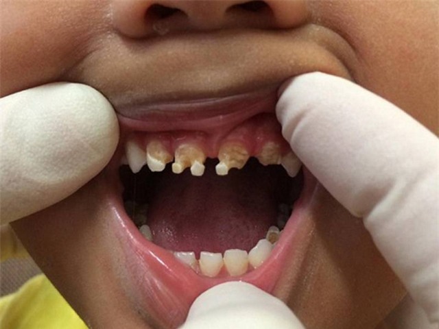 Trẻ thối hết cả hàm răng vì uống nhiều nước ngọt có ga - Ảnh 4.