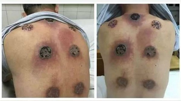 Nhập viện vì nhiễm trùng do giác hơi liên tục một tháng-1