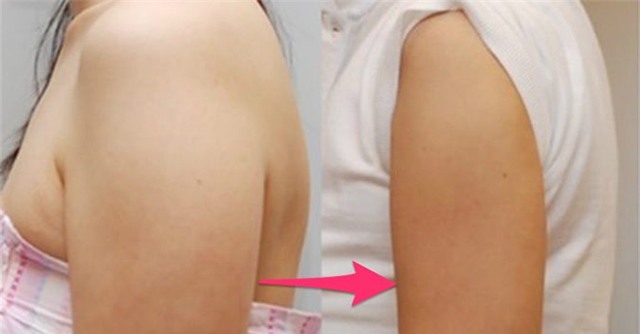 Cánh tay thon gọn