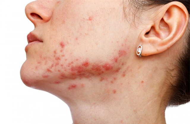 Tác hại nghiêm trọng của kem tẩy trắng da đối với sức khỏe - Ảnh 1.