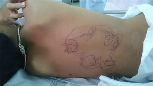 Bé trai được vẽ bùa vào lưng để trị bệnh. Ảnh: H.K