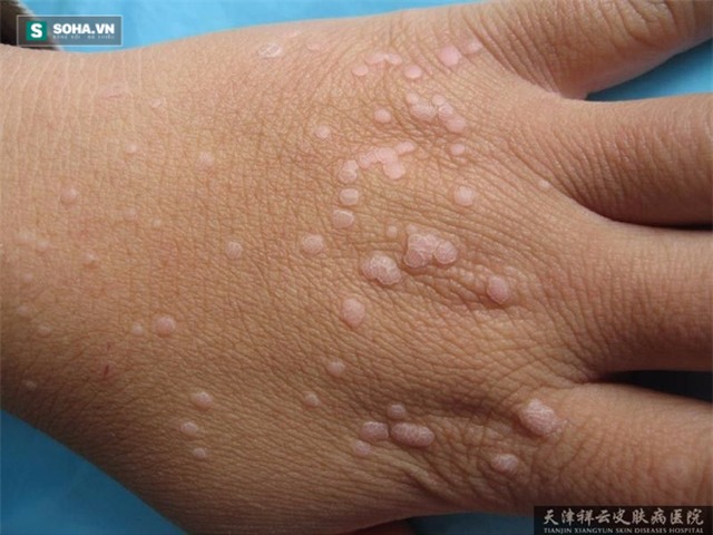 Bệnh mụn cóc phẳng – lây nhiễm nhanh, hậu quả ghê sợ - Ảnh 2.
