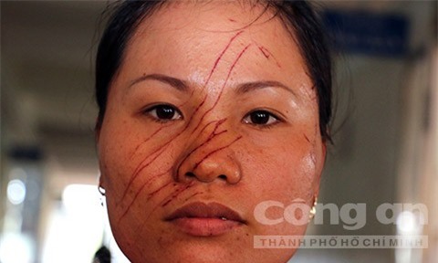 Vết rạch chi chít trên mặt chị Vân.