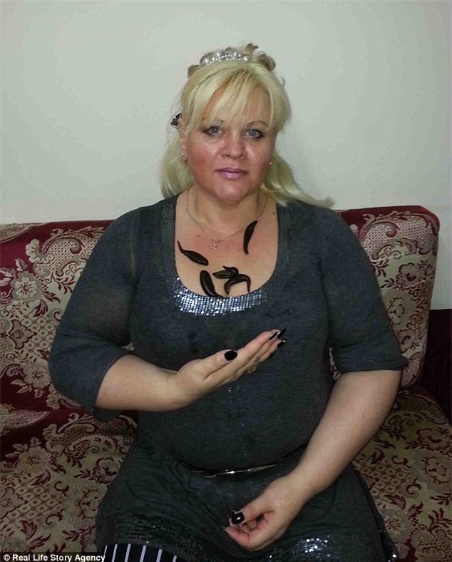 Người phụ nữ giảm được gần 60kg cân vì cho đỉa hút máu thoải mái - Ảnh 1.