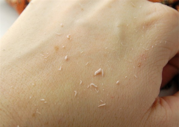 tẩy da chết dạng kỳ ghét