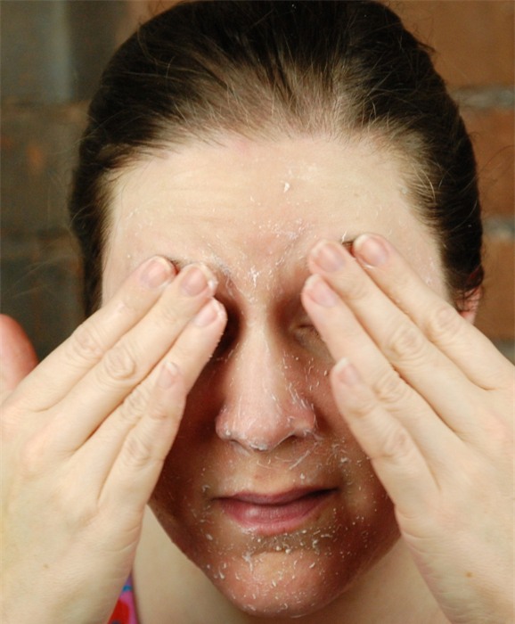 tẩy da chết dạng kỳ ghét