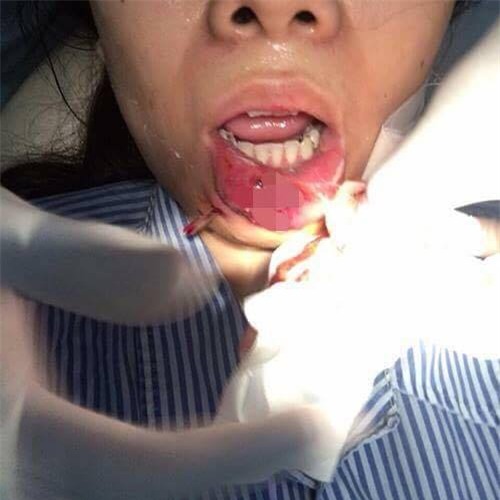 xot xa co gai quang ninh phai cat bo moi sau khi tiem chat lam day - 2