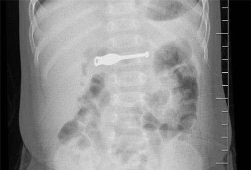 nuốt phải dị vật, nuốt que lấy ráy tai, dị vật