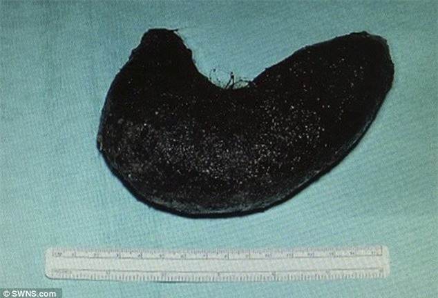 Bà mẹ nuốt hơn 6kg tóc vào bụng lúc ngủ - 1