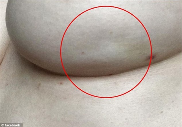 Bà mẹ 2 con chia sẻ dấu hiệu nhận biết ung thư từ 'lúm đồng tiền' trên vú