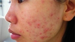 Làm thế nào để mụn biến mất nhanh chóng?